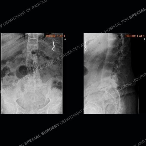 Hss Whats The Diagnosis Case 176 By Hospital For Special Surgery Issuu