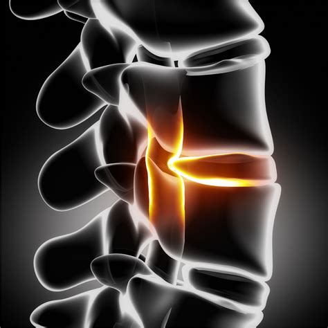 Ruptured Disc In Frisco American Neurospine Institute