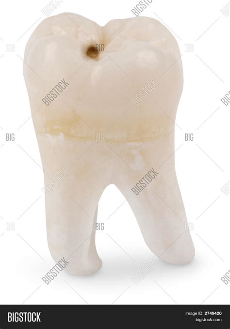 Wisdom Tooth Cavity Image & Photo (Free Trial) | Bigstock