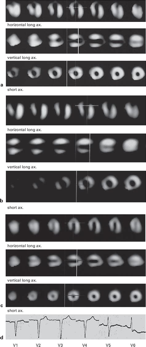 Figure From Normalization Of Negative T Waves In The Chronic Stage Of