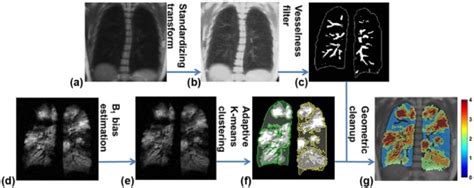 Semiautomated Ventilation Defect Quantification In Exercise Induced