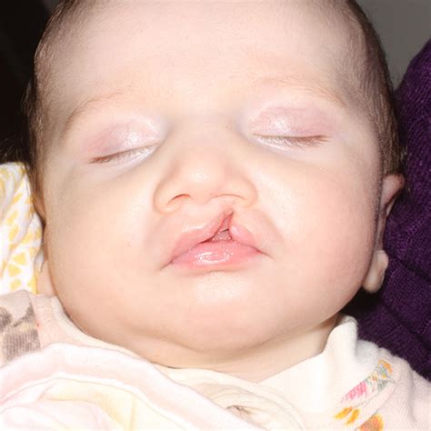 Cleft Lip And Palate Pensacola Oral And Facial Surgery Pensacola Fl