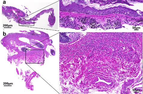 Hematoxylin And Eosin Stained Sections Of Biopsies Harvested From The