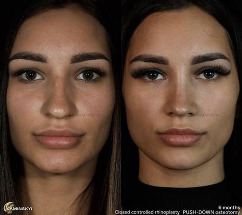 Pin By Carla Tejeda On Nose Job Nose Job Nose Plastic Surgery Nose Surgery Rhinoplasty