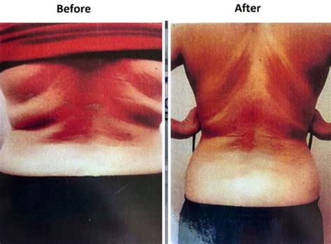 Back Braline Aesthetics Face And Bodysculpting