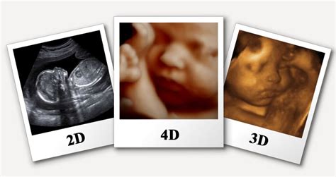 3d 4d Ultrasound Scan 4d Diagnostics