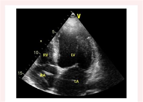 Preliminary Scheme Transthoracic Echocardiography Four Chamber View