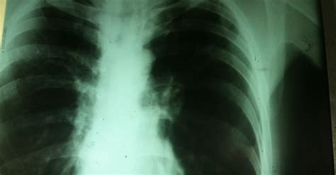 Aeymons Medical Life Lung X Ray Of An Asthma Patient