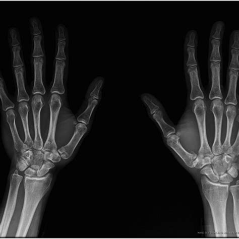 Initial Radiographic Assessment Of Patient With Bilateral Bennett S