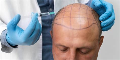 Hair Transplantation Process Complications And Side Effects Formen Health