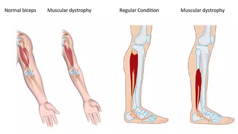 Who Gets Muscular Dystrophy