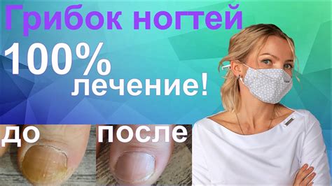 Грибок ногтей лечение/ Самое эффективное лечение грибка ногтей - YouTube