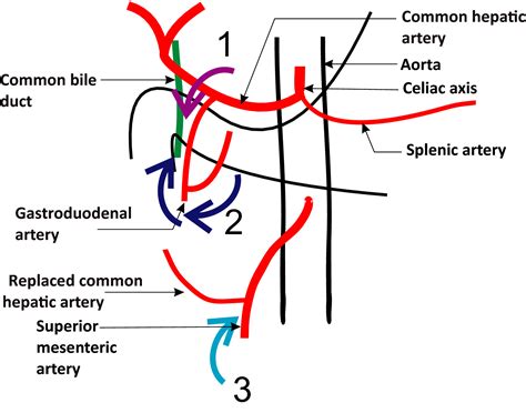 Gastroduodenal Artery