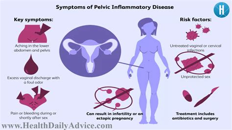 What Is Pelvic Inflammatory Disease Pid Health Daily Advice