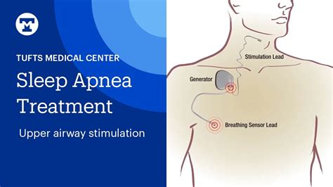 Sleep Apnea Treatment Upper Airway Stimulation Tufts Medical Center