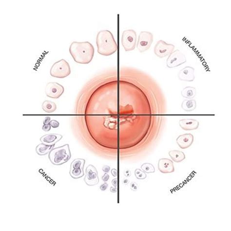 Abnormal Pap Smears Normal In Young Women