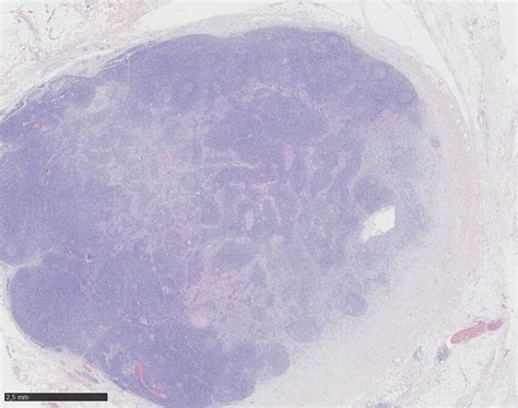 Lymph Node With Metastasis From P16 Oropharyngeal Squamous Cell Cancer Download Scientific