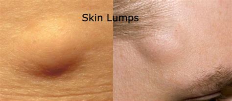 Skin Lump Surgery Singapore Lipoma Removal Procedure