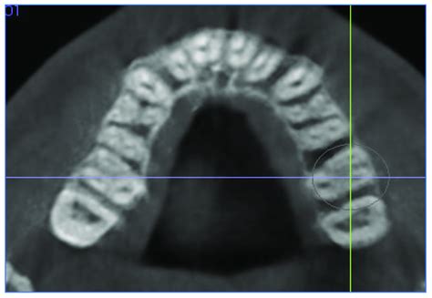 Cut In The Axial Plane For Buccal And Palatal Bone Thickness BBT And