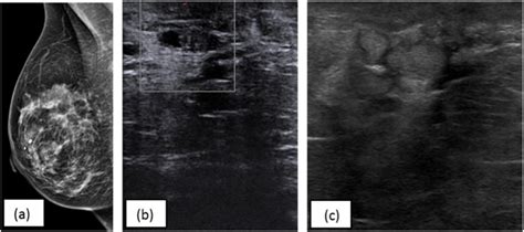 A Mammography Suggests A Retroareolar Cyst B Ultrasound Before