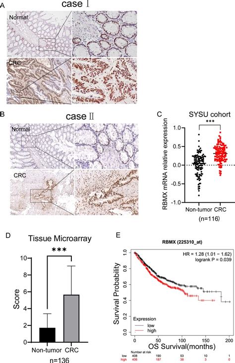 Iddf Abs Rbmx Promotes Tumor Plasticity And Immune Suppression