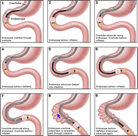 Enteroscopy Gastrointestinal Endoscopy