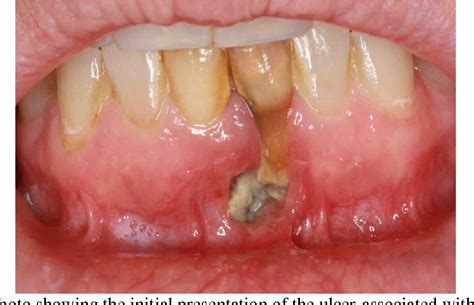 Figure 1 From Chronic Non Specific Ulcers In The Oral Cavity Can