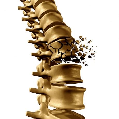 Osteoporotic Fracture - Dr Nikhil Arbatti