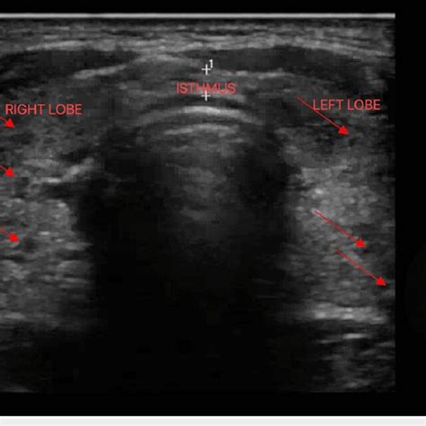 Ultrasound Of The Thyroid Gland Showing Enlarged Right And Left Lobes