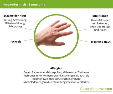 Diagnose Neurodermitis Ursachen Symptome Behandlung