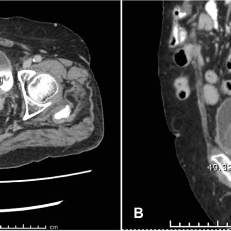 Axial A And Sagittal B Ct Scans Of The Whole Abdomen Included The