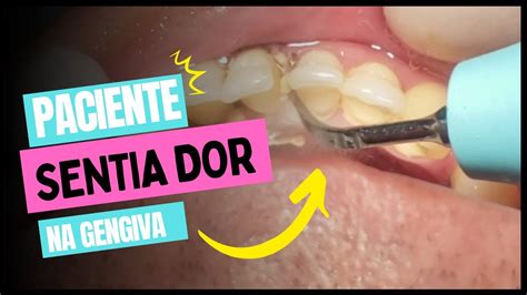 Raspagem para Remoção de Cálculo dental tártaro ultrassom YouTube