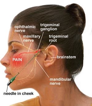 TRIGEMINAL NEURALGIA : causes , symptoms , treatments