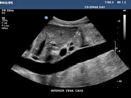 Intro To Sonography Final Flashcards Quizlet