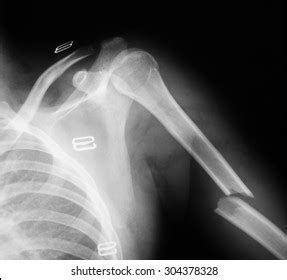 Xray Image Humerus Bone Lateral View Stock Photo 304378283 | Shutterstock