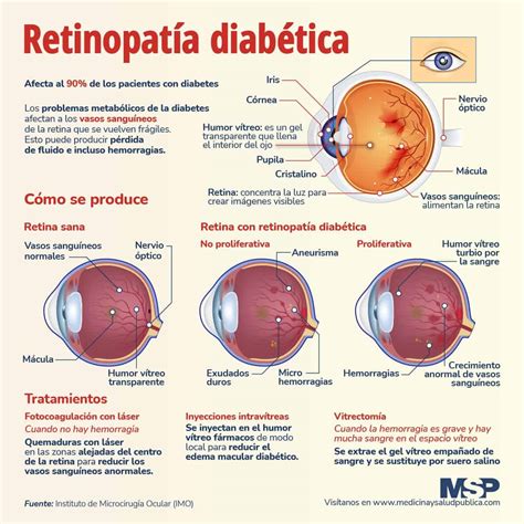 Retinopatía Diabética Infografía