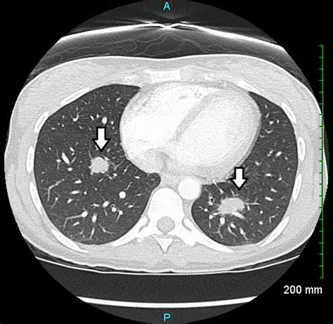 Sarcoidosis Lung Nodules