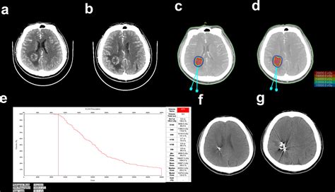 Frontiers Iodine 125 Brachytherapy Treatment For Newly Diagnosed