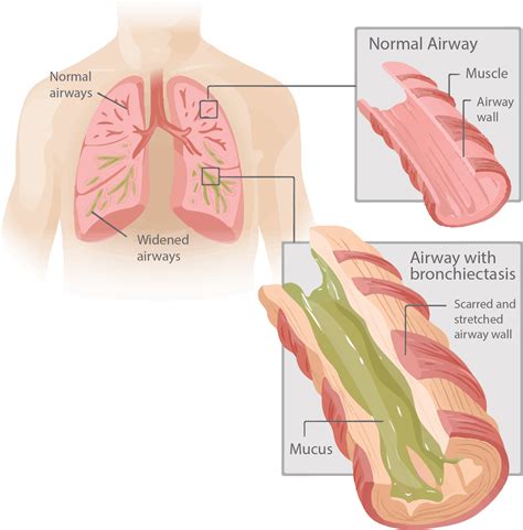 Bronchiectasis Lung Care Foundation