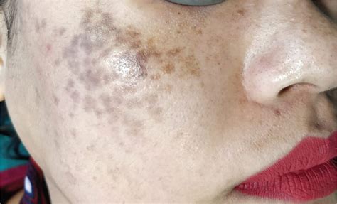 Horis Pigmentation Horis Nevus Treatment Effective Laser Solution