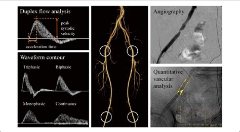 Assessment Of Lower Extremity Arterial Flow And Lesions Left