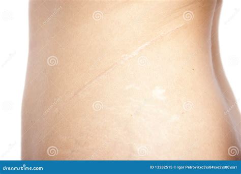 Kidney Operation Scar Royalty Free Stock Photo - Image: 13282515