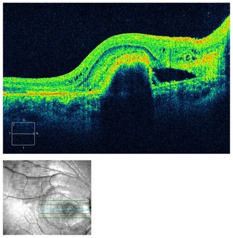 Full Article Bilateral Choroidal Neovascularization Associated With Optic Nerve Head Drusen