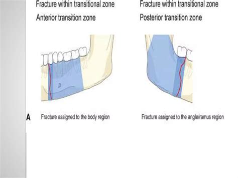 Classification Of Mandible Fracture Ppt