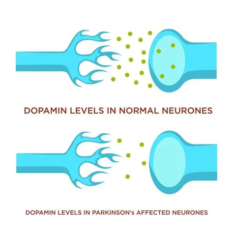 Neuronas Normales Y Con Enfermedad De Parkinson Nivel De Dopamina