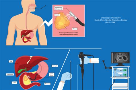 Endoscopic Ultrasonography Dr Bansal And Associates