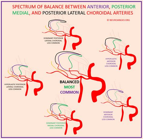 Anterior Choroidal Artery | neuroangio.org