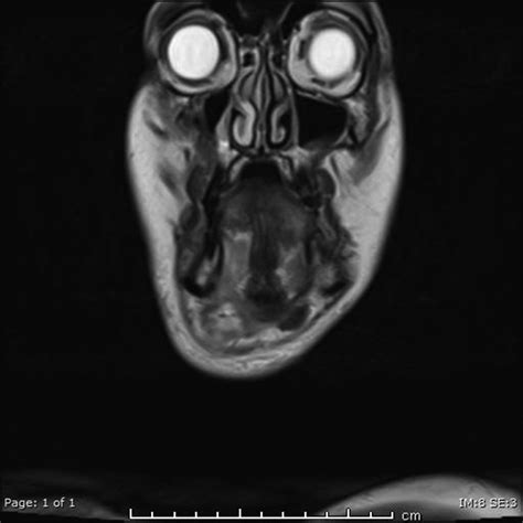 Abscess Of The Anterior Belly Of The Digastric Muscle A Case Report