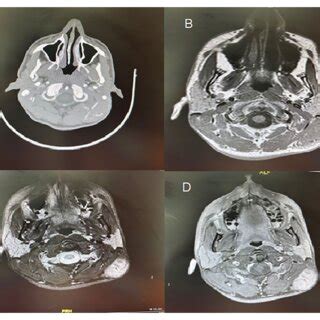 A Contrast Enhanced CT Axial Cut Demonstrating Slightly Hyperdense