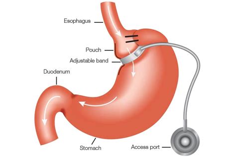 Adjustable-Gastric-Banding-DS-Surgery - DSSurgery